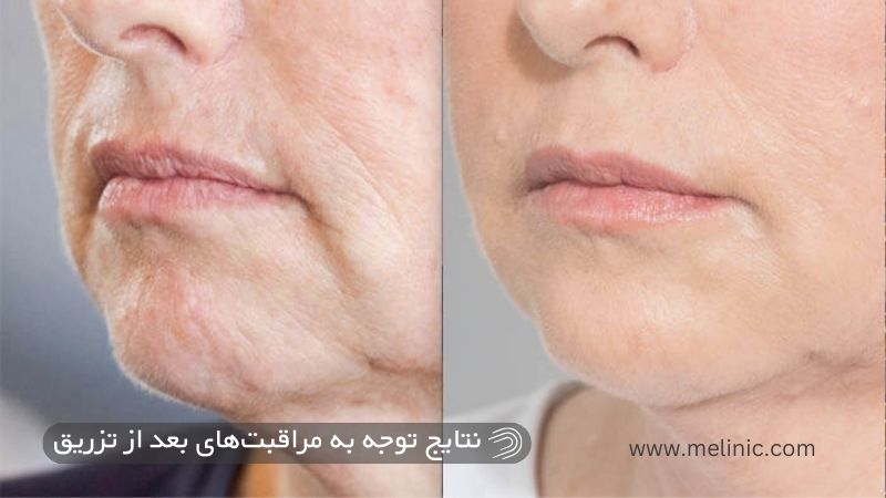 مزایای توجه به مراقبت های بعد از تزریق ژل خط غم 