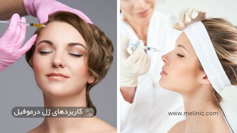 کاربردهای ژل درموفیل