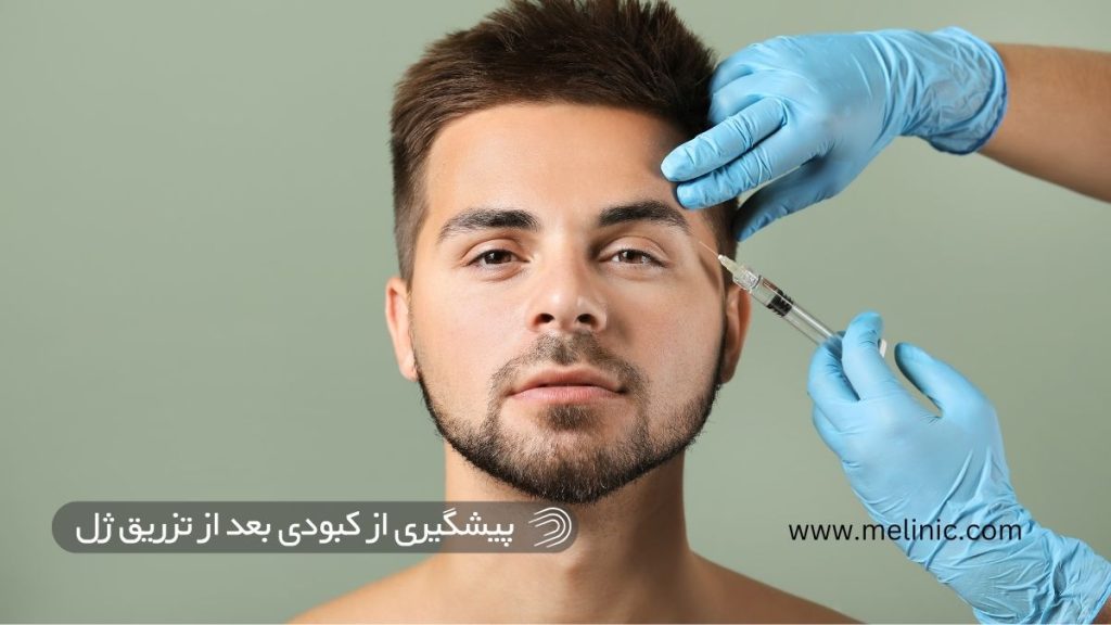 پیشگیری از کبودی بعد از تزریق ژل