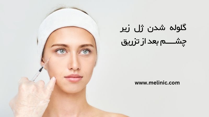 گلوله شدن ژل زیر چشم بعد از تزریق