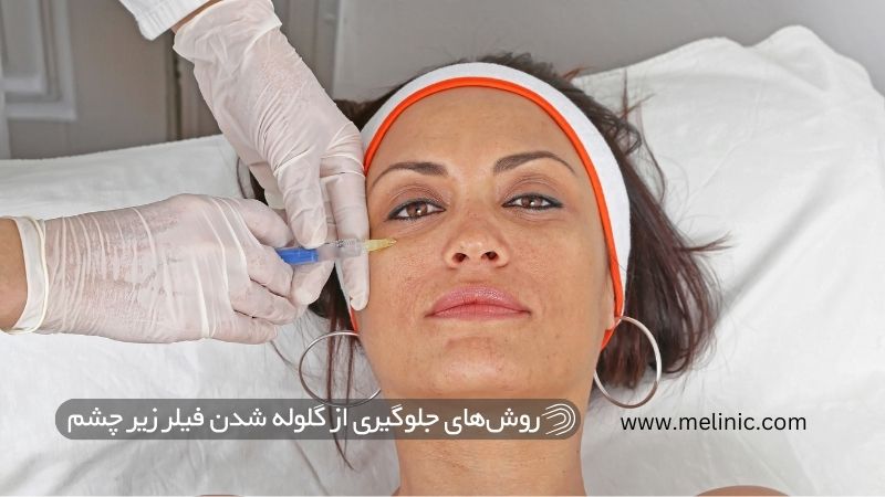 روش‌های جلوگیری از گلوله شدن فیلر زیر چشم