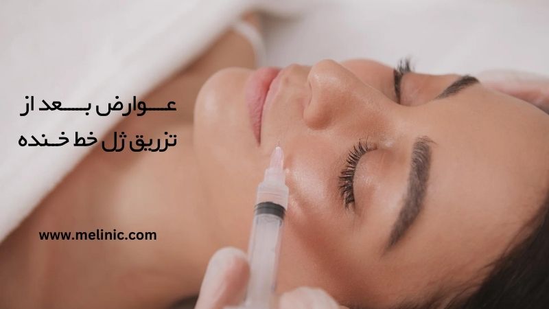 عوارض بعد از تزریق ژل خط خنده