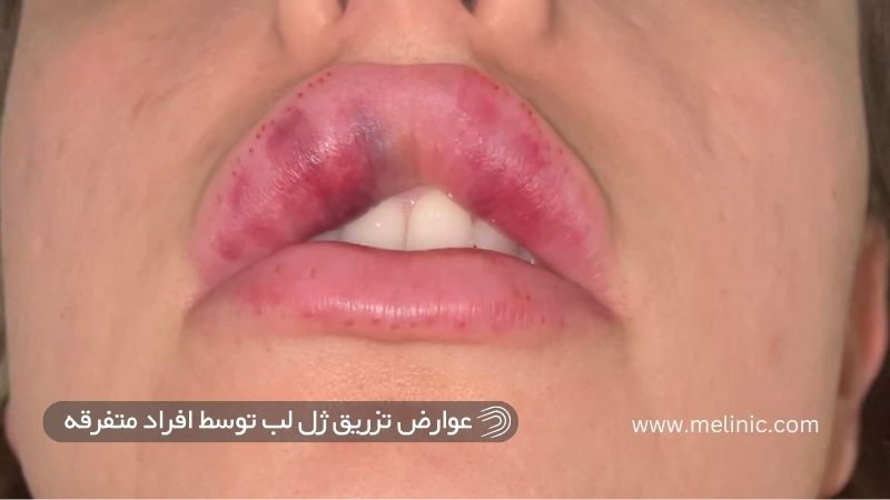 عوارض تزریق ژل لب توسط افراد متفرقه