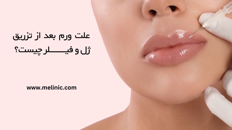 علت ورم بعد از تزریق ژل چیست؟