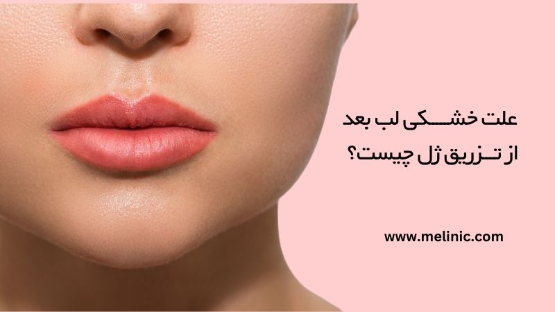 علت خشکی لب بعد از تزریق ژل چیست؟